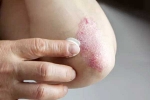 Skin disorders articles, Skin disorders related, five common skin disorders and their symptoms, Acne
