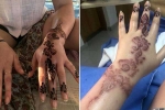 henna tattoo, black henna tattoo burns, henna tattoo cause aussie woman to almost lose her hand, Aswan