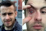 contact lenses in wate, contact lens users, contact lens wearers beware man goes blind after parasites eat man s eye as he wore lenses in shower, Eyesight