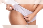 stretch marks photography, white stretch marks, difference between red and white stretch marks explained and it s natural to have them, Stretch marks