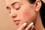 home remedies, pimples, 10 ways to get rid of pimples at home, Acne