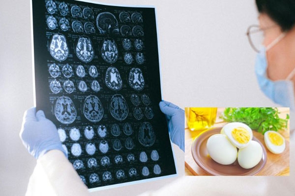 Eggs May Help Prevent Alzheimer’s: Study